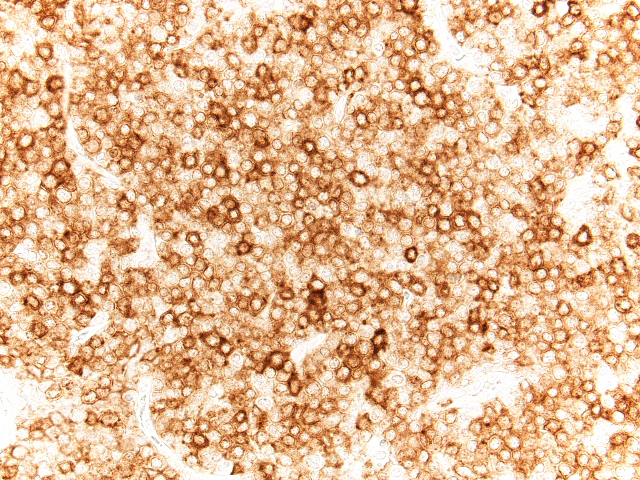 Lymph node biopsy, lymphoid-predominant area, CD7